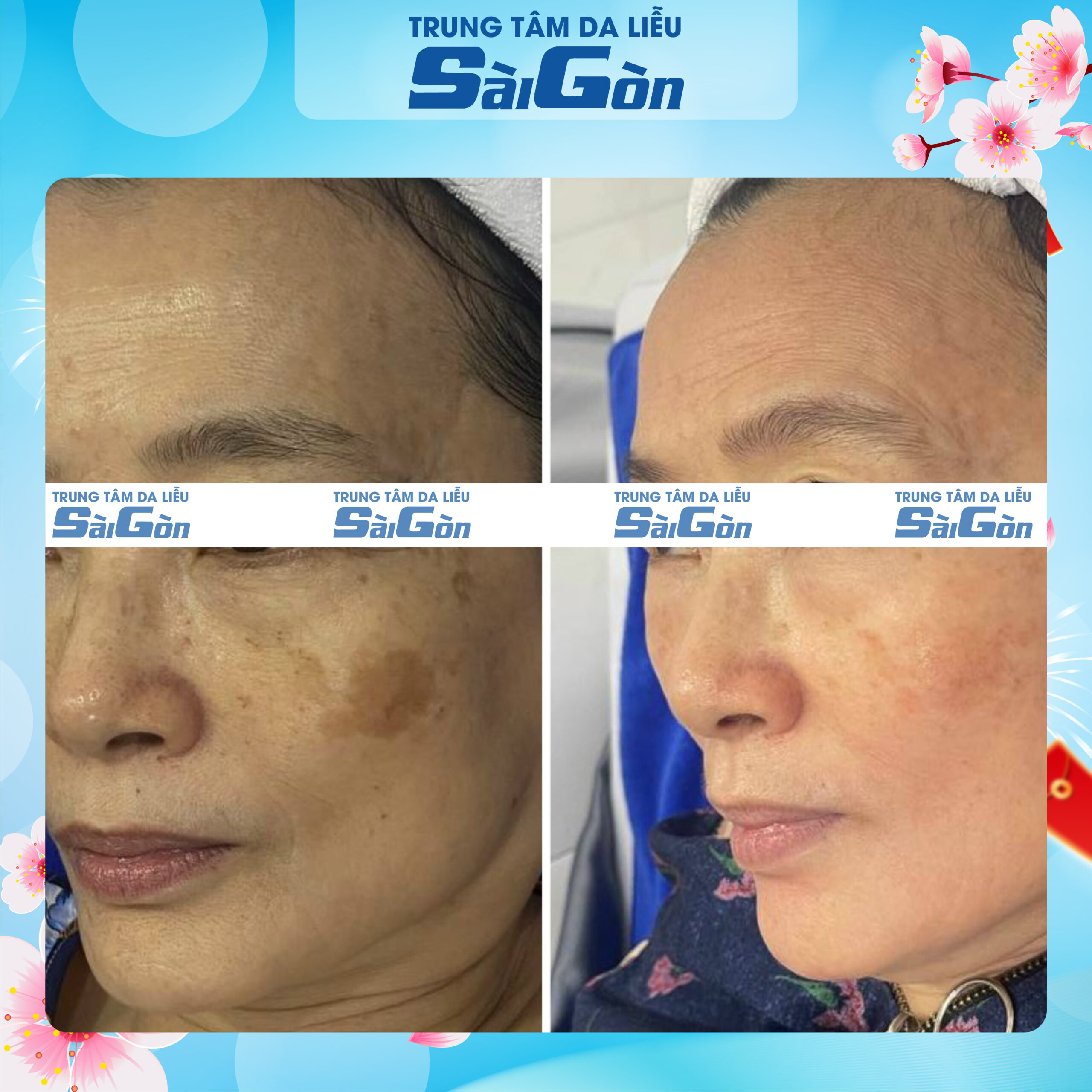 trị tàn nhang tại da liễu sài gòn