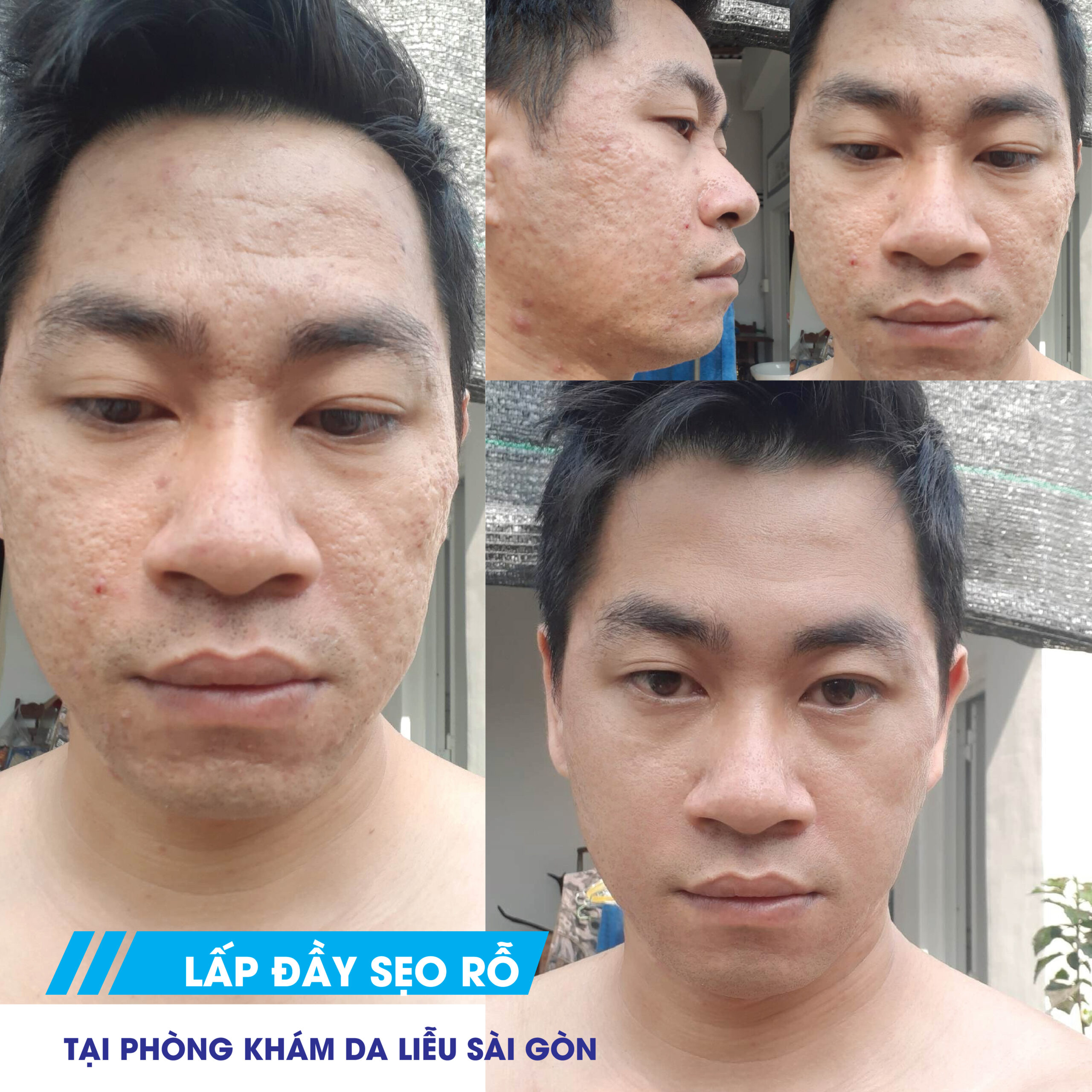 Sẹo Rỗ Tại Phòng Khám Da Liễu Sài Gòn