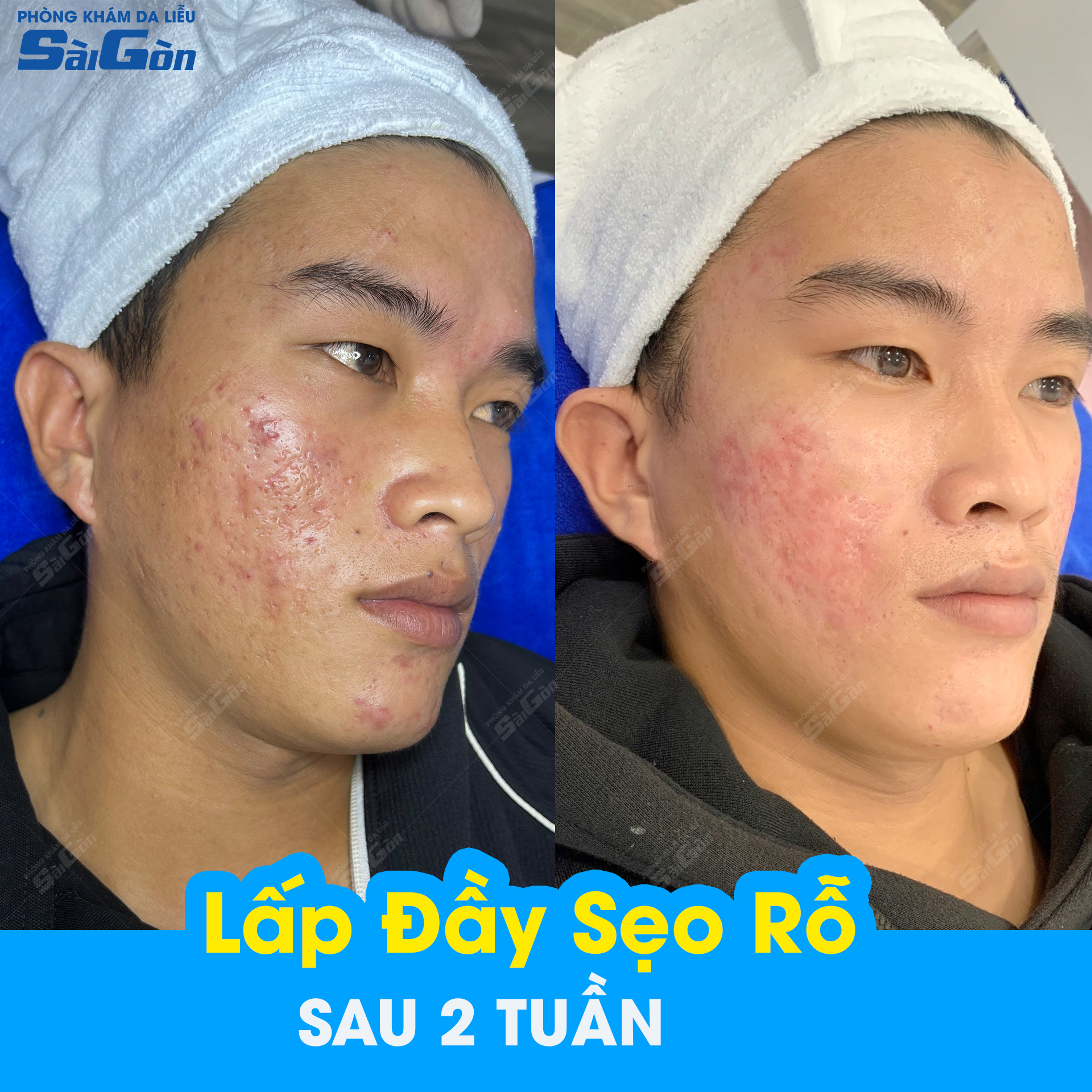 lấp đầy sẹo rỗ tại trung tâm da liễu sài gòn