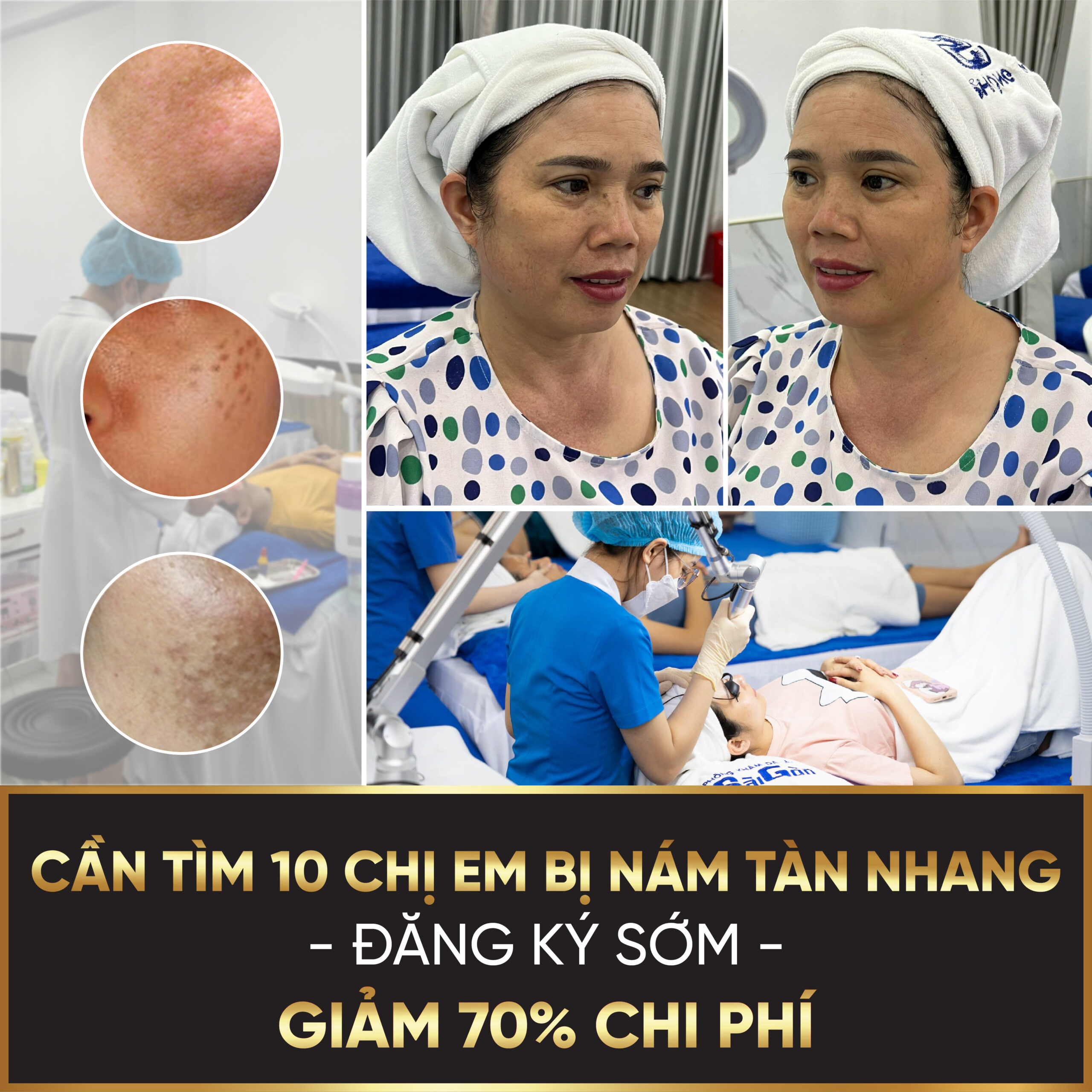 Trị nám hiệu quả tại da liễu sài gòn