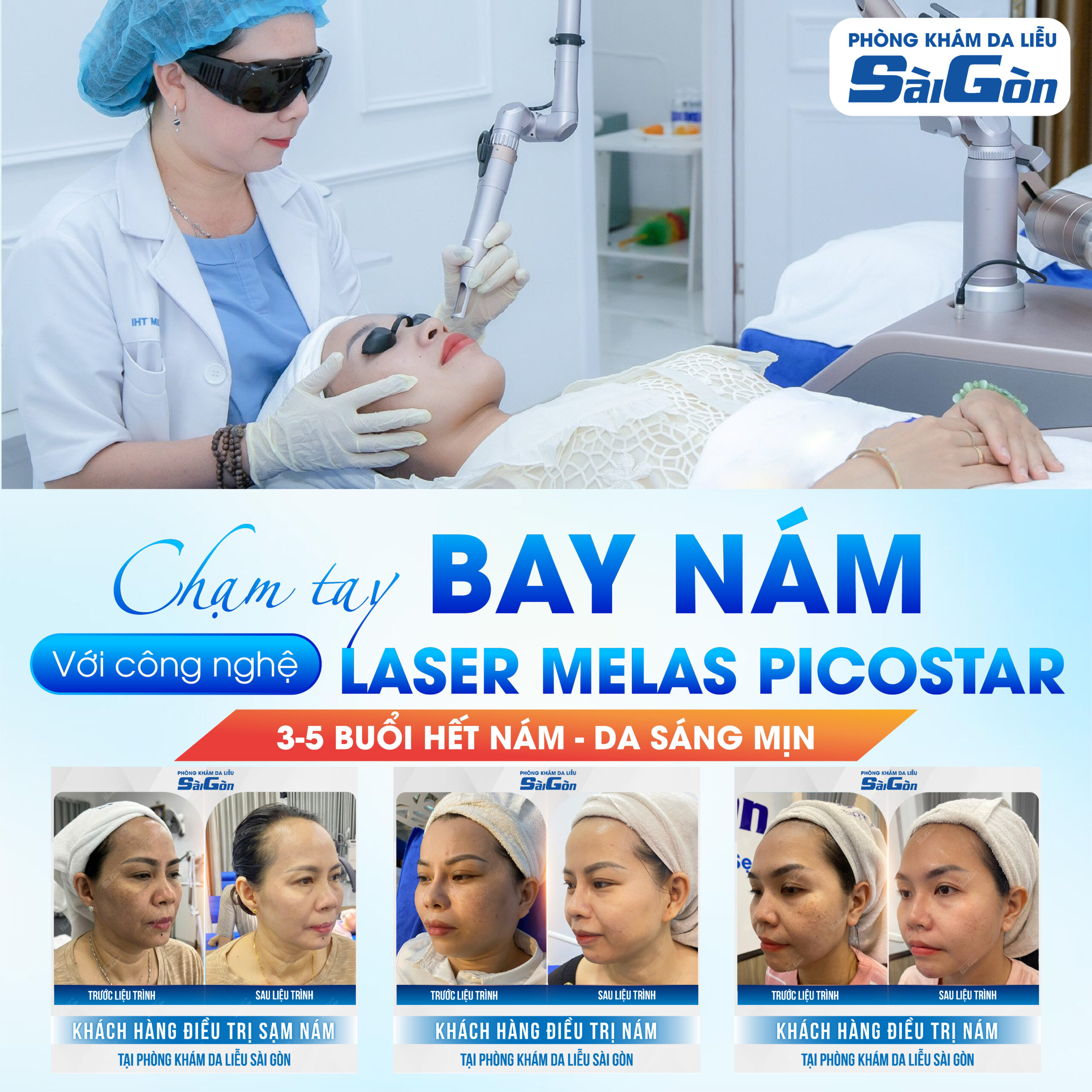 Điều trị nám tàn nhang tại nha trang