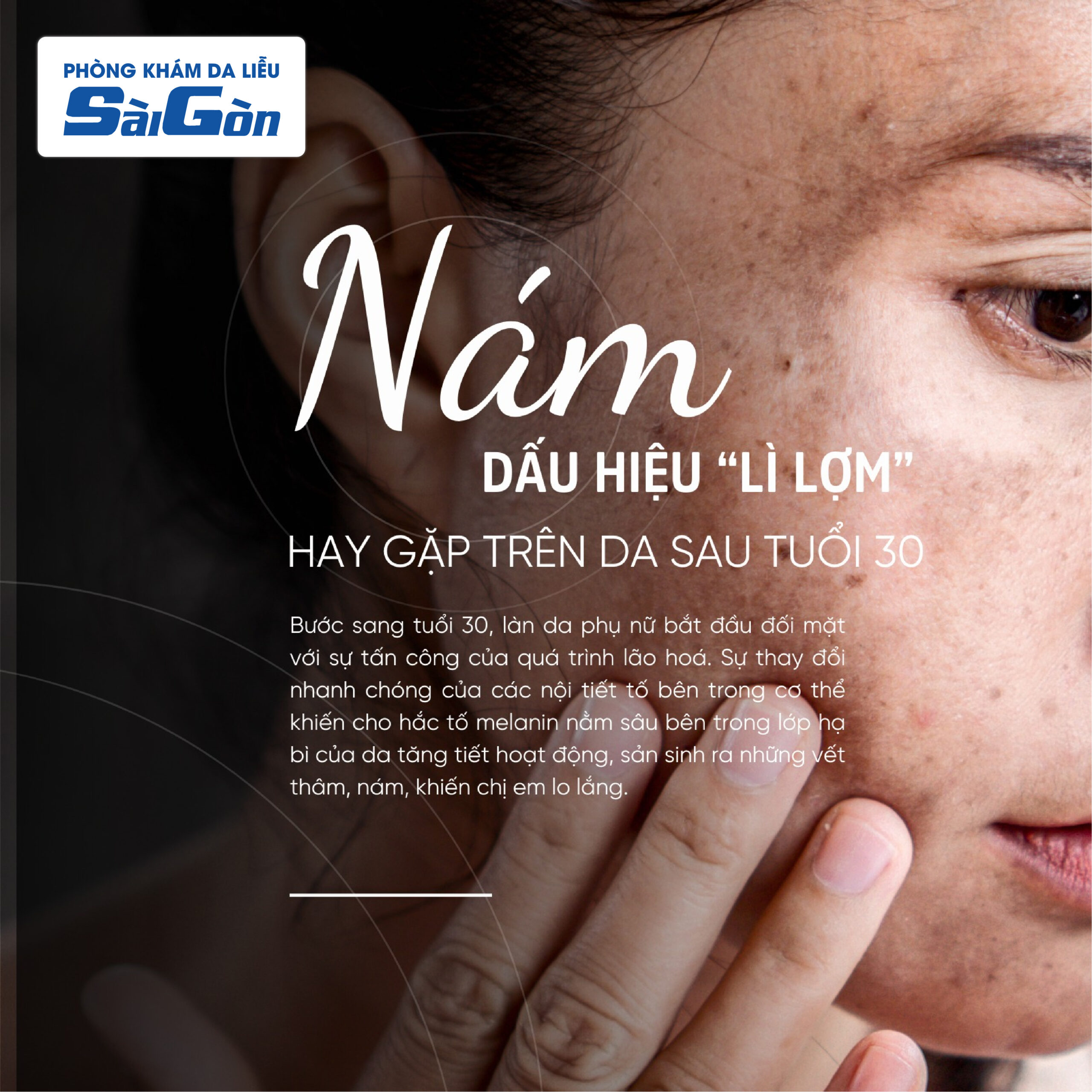 Điều trị Nám Tàn Nhang tại Nha Trang