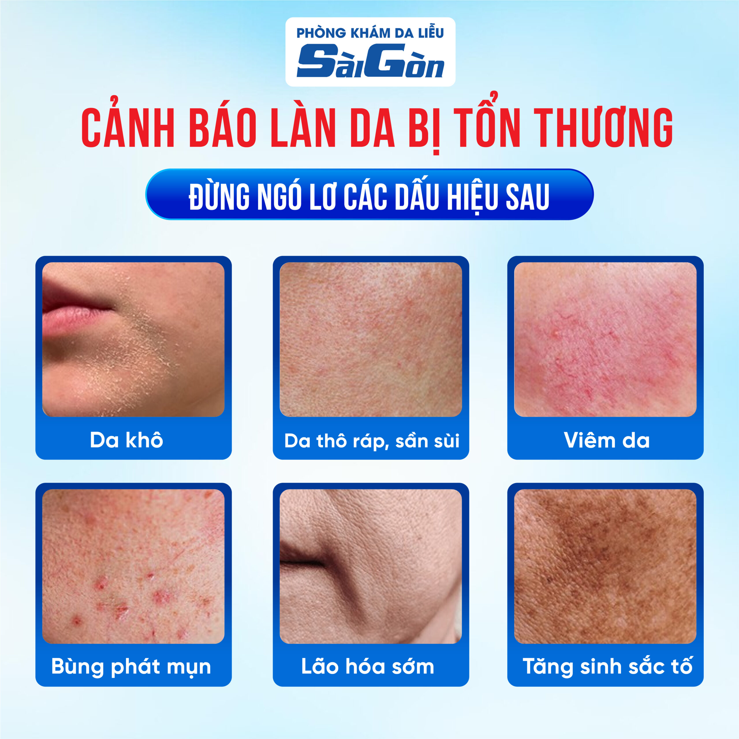Nám Tàn Nhang điều trị ở nha trang