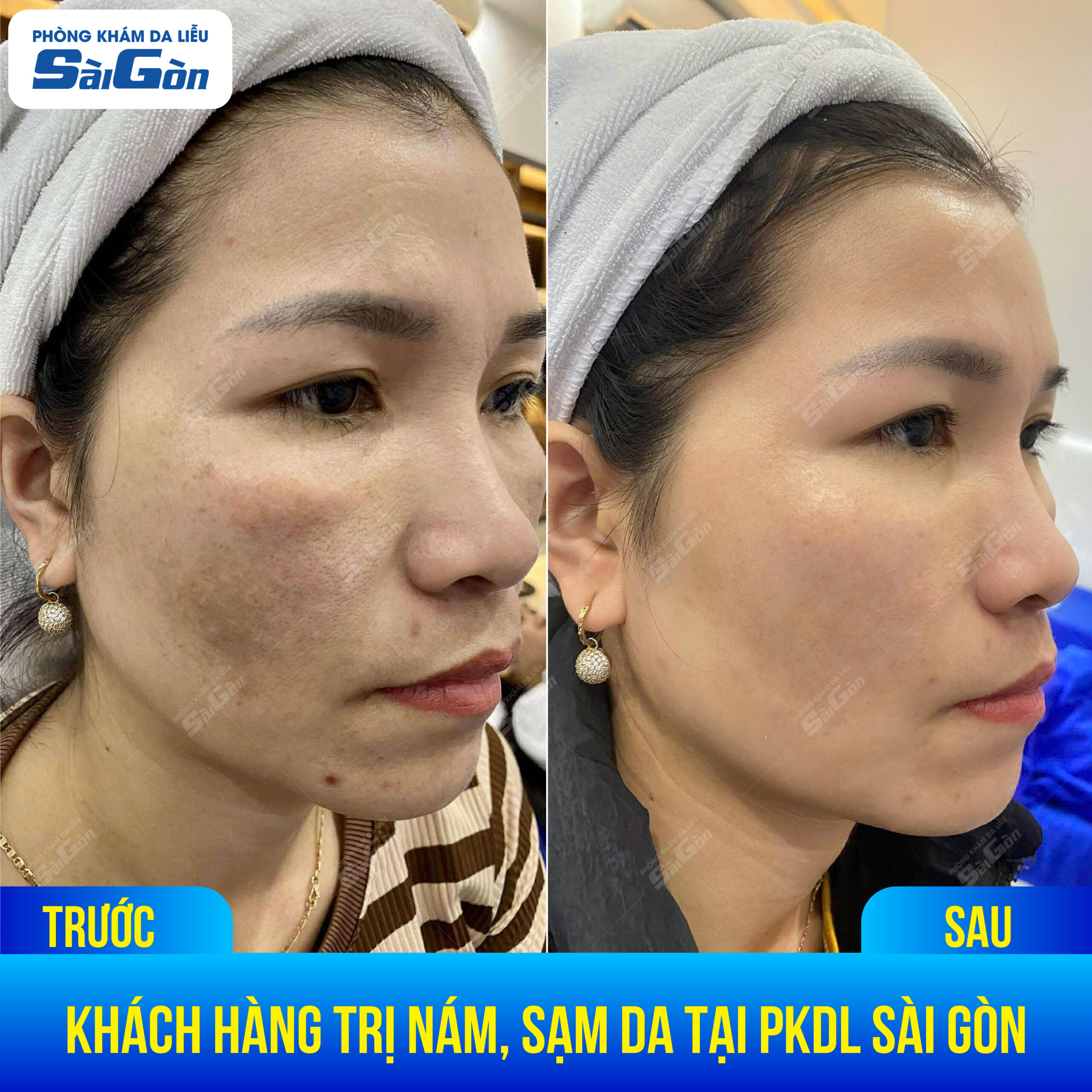 Điều trị nám da